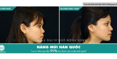 Nâng mũi bằng chỉ vàng 24k giá bao nhiêu