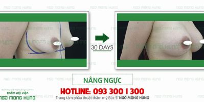 Vì sao ngực bị chảy xệ? Cách khắc phục ra sao?