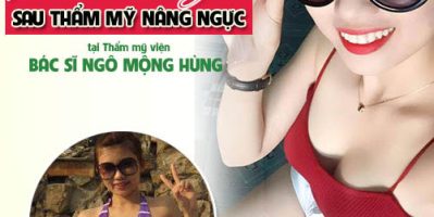 Nâng ngực chảy xệ bằng phương pháp nội soi ở đâu?