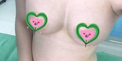 Nâng ngực chảy xệ ở đâu đẹp và an toàn nhất hiện nay?