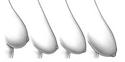 Ngực chảy xệ là gì và cách chữa hiệu quả nhất hiện nay