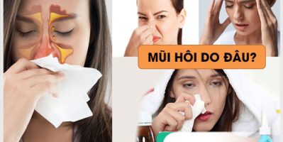Lỗ mũi có mùi hôi dấu hiệu của bệnh viêm xoang