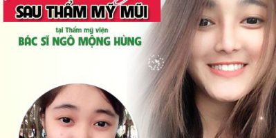 Xu hướng nâng mũi đẹp nhất hiện nay là gì