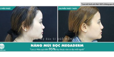 Sửa sóng mũi bao nhiêu tiền tại SG