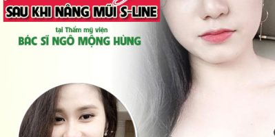 Nâng mũi dài ở đâu đẹp