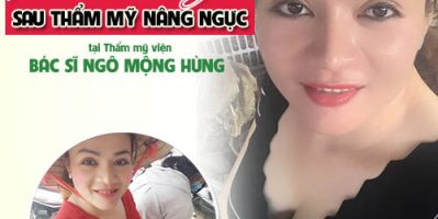 Một bên ngực bị xệ phải làm sao? Chuyên gia tư vấn
