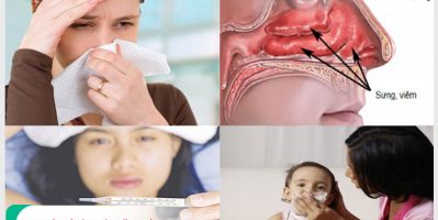 Cơ chế lây bệnh của viêm mũi dị ứng