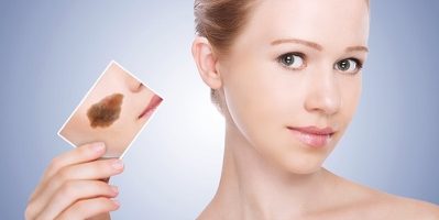 Giải pháp hoàn hảo giúp bạn xóa chàm đỏ bẩm sinh