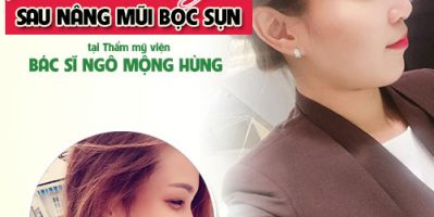 Sản phẩm cây nâng mũi giá bao nhiêu