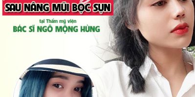 Nên lựa chọn sửa lại mũi bị lệch không