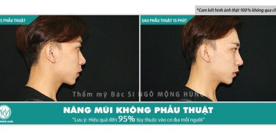 Nâng mũi không phẫu thuật bằng restylane perlane