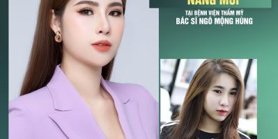 Phương pháp nâng mũi bằng goretex