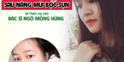 Nâng mũi ở cà mau có đẹp không