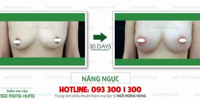 Cách khắc phục ngực chảy xệ
