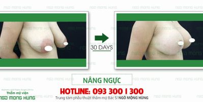 Hậu sinh xong ngực chảy xệ phải làm sao