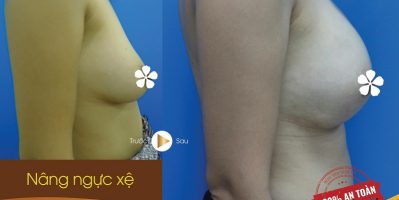 Nơi sản xuất túi nâng ngực chảy xệ với chỉ thẩm mỹ Hàn