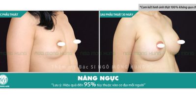Thuốc nở ngực an toàn nhất nên dùng loại nào