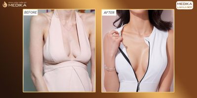 Ngừng kinh doanh nâng ngực chảy xệ ở Hàn từ tập đoàn lớn