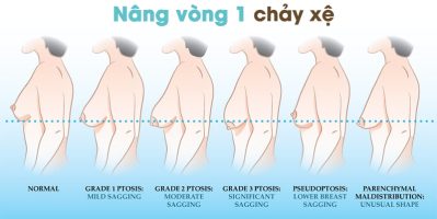Thương hiệu nâng ngực chảy xệ tùy chỉnh từ viện thẩm mỹ Medika