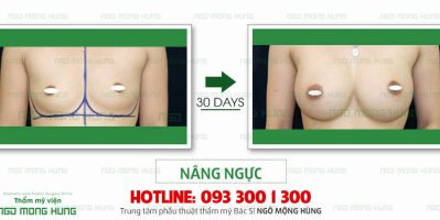 Nâng ngực đau bao lâu thì lành