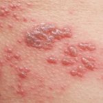 Bị zona thần kinh kiêng gì? – Góc chia sẻ