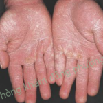 Nấm da tay và cách điều trị nấm da tay hiệu quả
