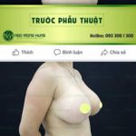 Công dụng của áo lót nâng ngực chảy xệ là gì