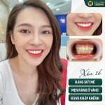 Những hàm răng sứ đẹp là như thế nào? Nhakhoasunshine