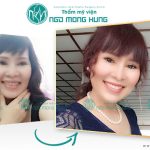 Xem tham khảo hình ảnh căng da mặt bằng chỉ