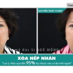 Xóa nếp nhắn ở gò má cách nào nhanh nhất