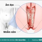 Hướng dẫn các phương pháp tự chữa nấm âm đạo tại nhà