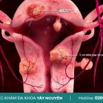 Tìm hiểu xem các biểu hiện của u xơ cổ tử cung là gì?