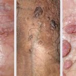 Phòng Khám Chữa Sùi Mào Gà Ở Hà Nội uy tín và chất lượng