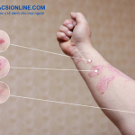 Làm sao để chữa bệnh chàm khô an toàn và hiệu quả