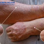 Cách điều trị bệnh chàm khô tróc vảy hiệu quả và an toàn