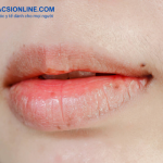 Những loại thuốc bôi chàm môi phổ biến và cách dùng đúng cách