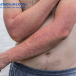 Thuốc trị chàm tổ đỉa được bác sĩ khuyên dùng để giảm nhanh triệu chứng