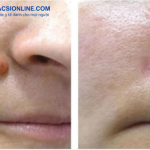 Da thay đổi thế nào sau khi tẩy nốt ruồi qua hình ảnh thực tế