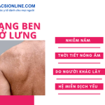Tìm hiểu các loại thuốc trị lang ben ở lưng hiệu quả hiện nay
