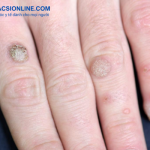 Mẹo chữa mụn cóc dân gian đơn giản hiệu quả ngay tại nhà