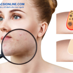 Cách trị mụn bọc sưng đỏ hiệu quả và an toàn tại nhà