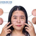 Thuốc trị lang ben ở mặt tại nhà an toàn và hiệu quả được bác sĩ khuyên dùng