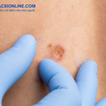 Tẩy nốt ruồi bị thâm phải làm sao để không để lại sẹo