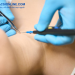 Quy trình tẩy nốt ruồi bằng đốt điện như thế nào?