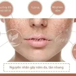 Hiểu nám da về nguyên nhân cho điều trị hiệu quả