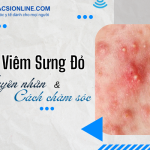 Nguyên nhân gây mụn viêm sưng đỏ và phương pháp điều trị hiệu quả
