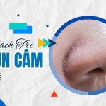 Tìm hiểu cách trị mụn cám tại nhà đơn giản và nhanh gọn