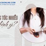 Rụng tóc nhiều là bệnh gì và cách điều trị hiệu quả