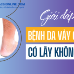Bệnh da vảy cá có lây không và triệu chứng thường gặp trên da