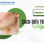 Bật mí cách điều trị mụn hiệu quả và an toàn cho mọi loại da